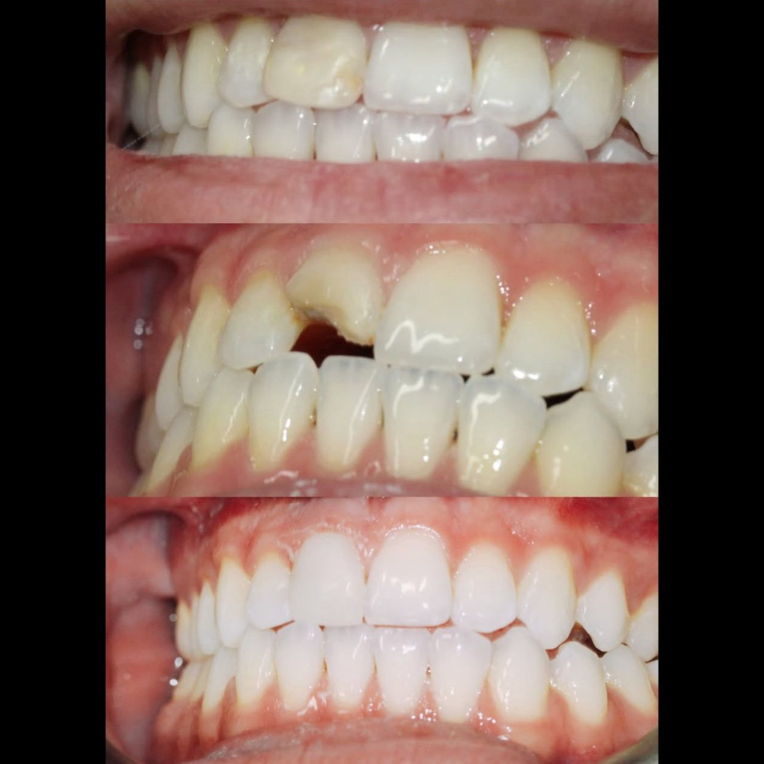 Whitening and Bonding