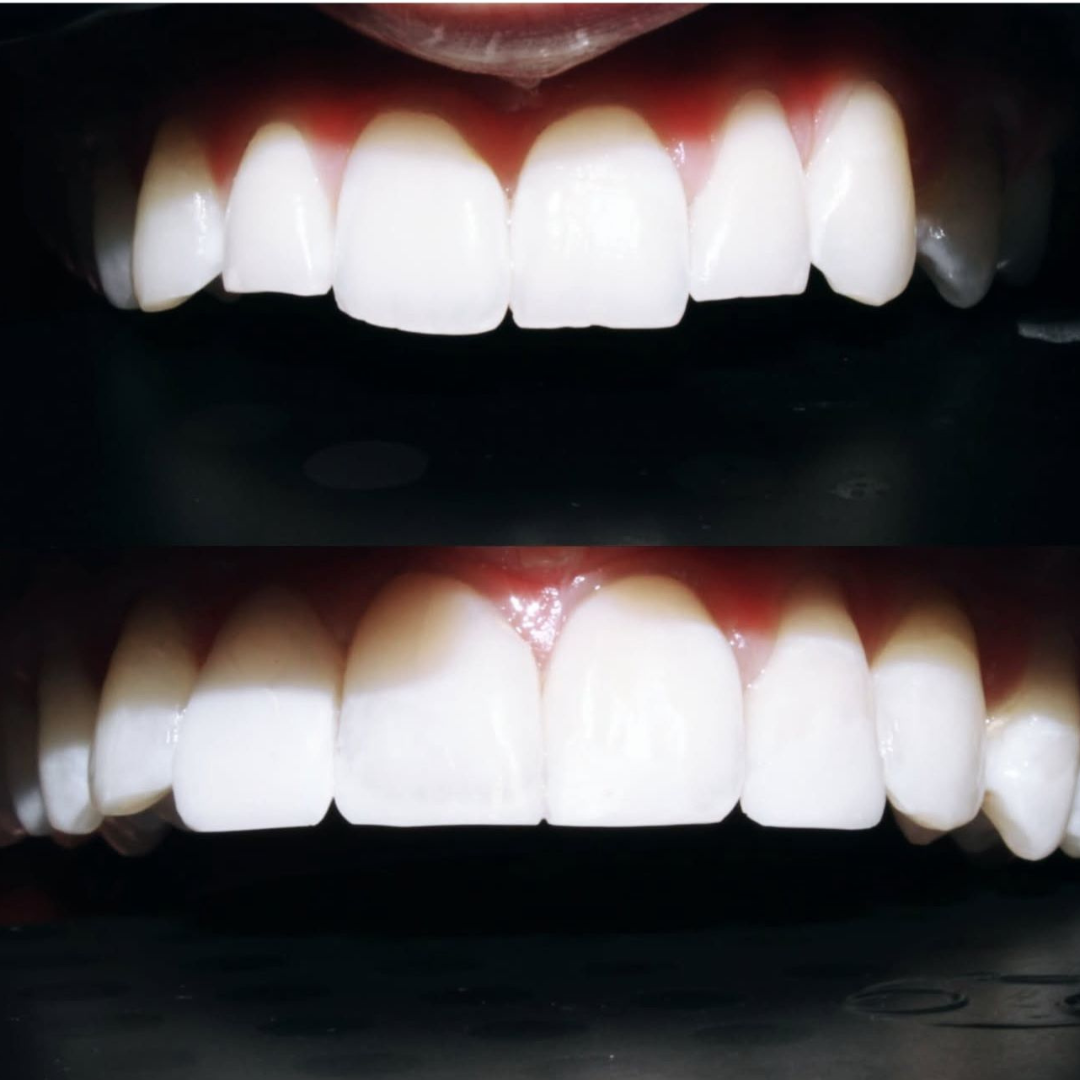 Composite Edge Bonding