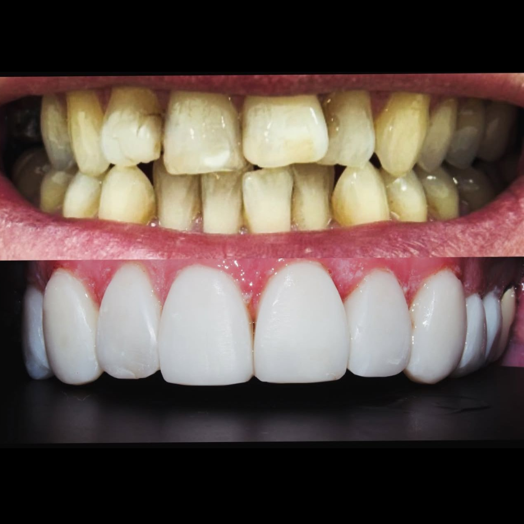 Invisalign and Composite Bonding